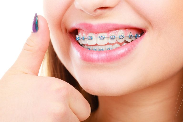 Что такое брекеты